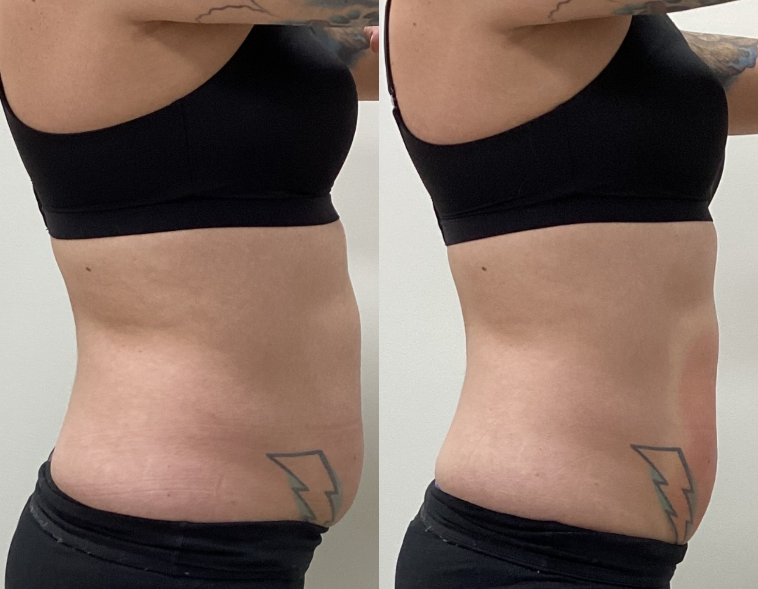 Before and after result 5